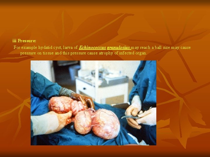 iii Pressure: For example hydatid cyst, larva of Echinococcus granulosius may reach a ball iii Pressure: For example hydatid cyst, larva of Echinococcus granulosius may reach a ball