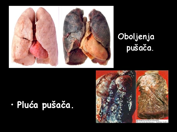 • • • Pluća pušača. Oboljenja pušača. • • • Pluća pušača. Oboljenja pušača.