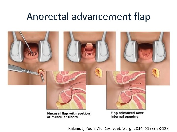 Anorectal advancement flap Rakinic J, Poola VP. Curr Probl Surg. 2014. 51 (3): 98