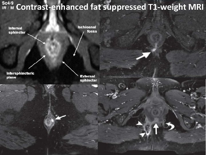 Contrast-enhanced fat suppressed T 1 -weight MRI 