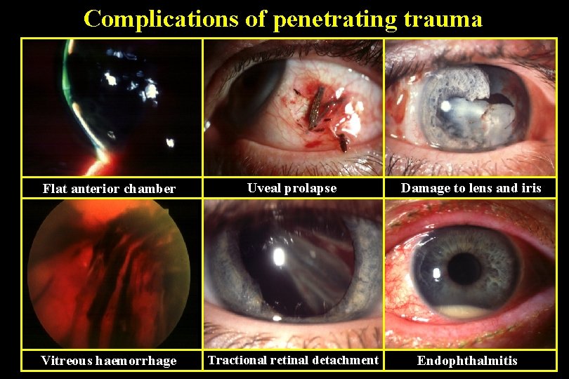 Complications of penetrating trauma Flat anterior chamber Uveal prolapse Vitreous haemorrhage Tractional retinal detachment