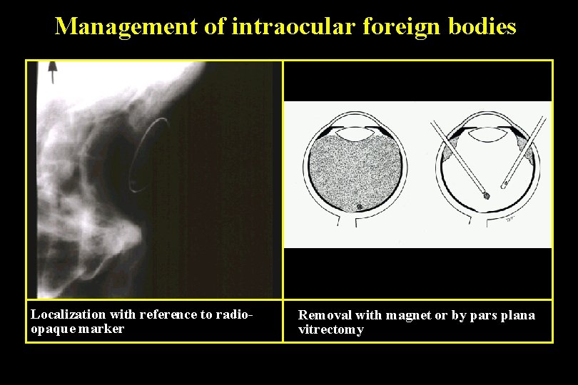 Management of intraocular foreign bodies Localization with reference to radioopaque marker Removal with magnet