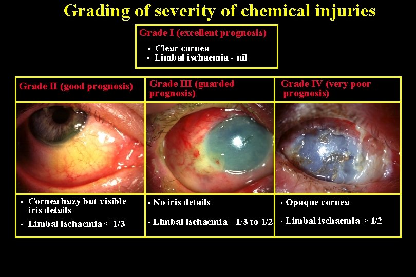 Grading of severity of chemical injuries Grade I (excellent prognosis) • • Grade II
