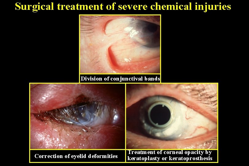 Surgical treatment of severe chemical injuries Division of conjunctival bands Correction of eyelid deformities