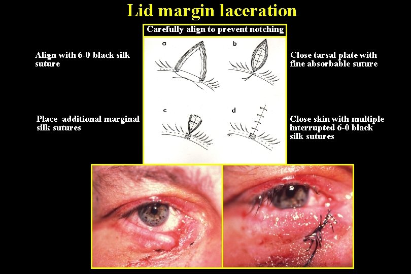 Lid margin laceration Carefully align to prevent notching Align with 6 -0 black silk