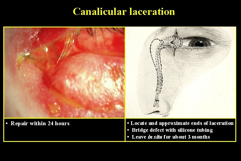 Canalicular laceration • Repair within 24 hours • Locate and approximate ends of laceration