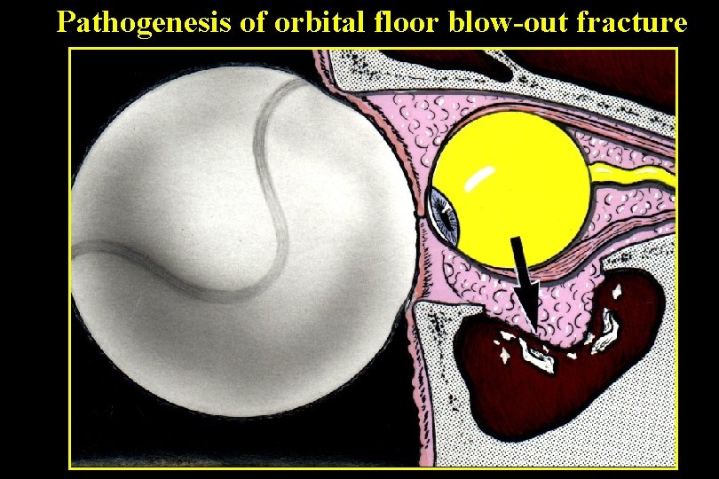 Pathogenesis of orbital floor blow-out fracture 