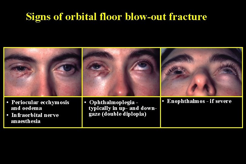 Signs of orbital floor blow-out fracture • Periocular ecchymosis and oedema • Infraorbital nerve