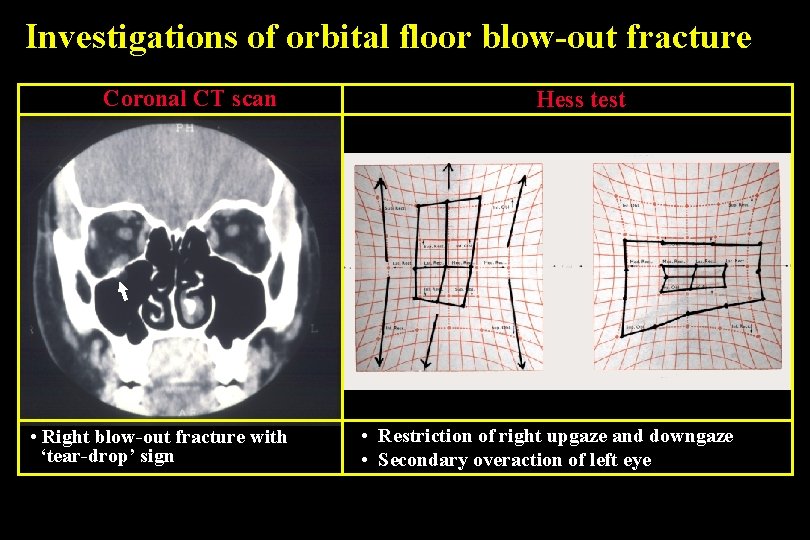 Investigations of orbital floor blow-out fracture Coronal CT scan • Right blow-out fracture with