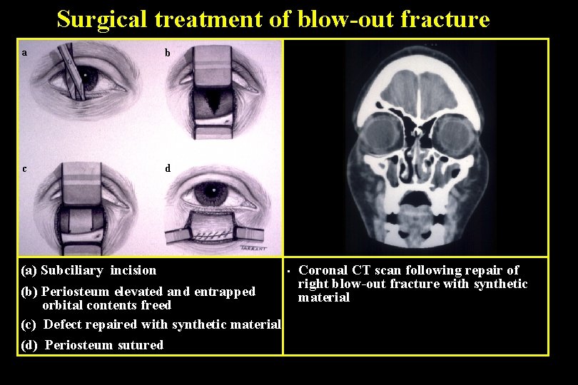 Surgical treatment of blow-out fracture a b c d (a) Subciliary incision (b) Periosteum