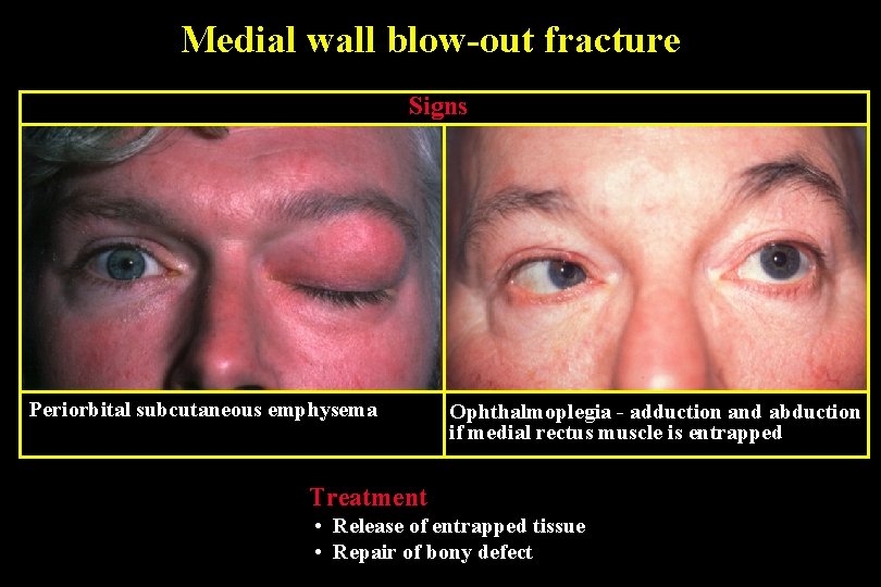 Medial wall blow-out fracture Signs Periorbital subcutaneous emphysema Ophthalmoplegia - adduction and abduction if