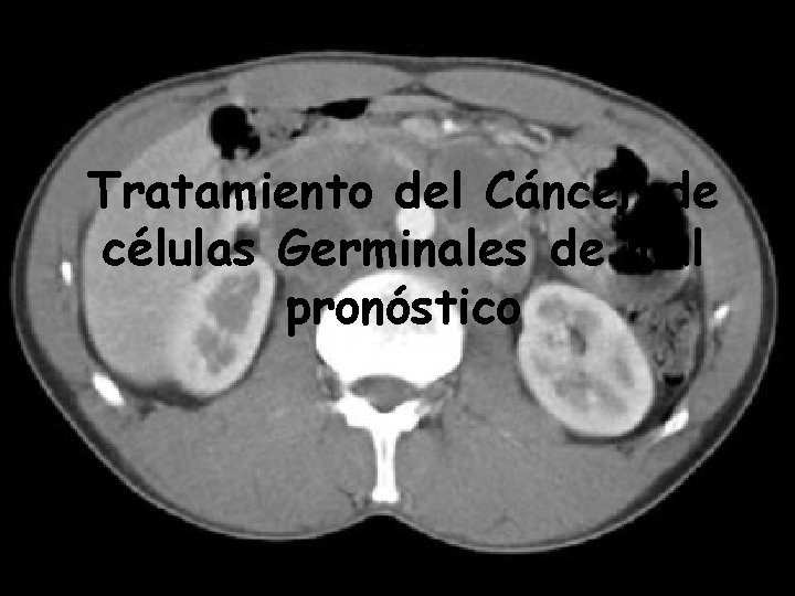 Tratamiento del Cáncer de células Germinales de mal pronóstico 