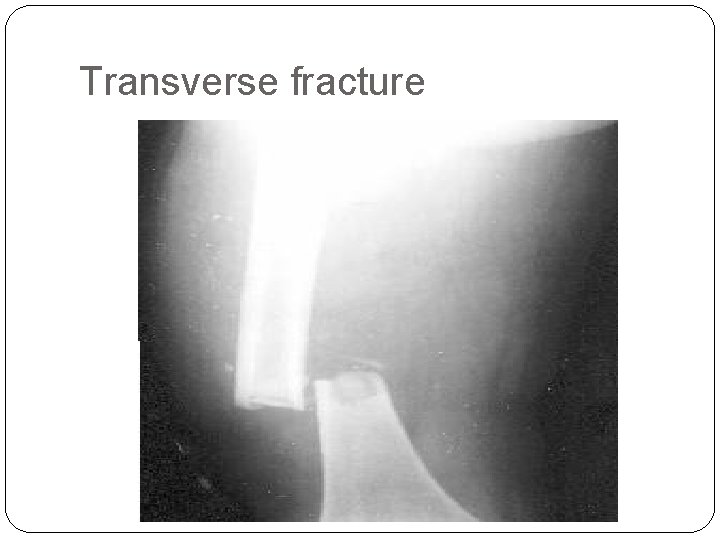 Transverse fracture 