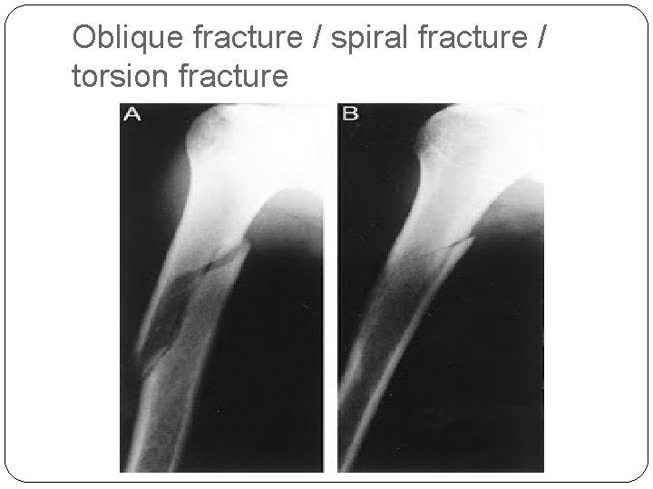 Oblique fracture / spiral fracture / torsion fracture 