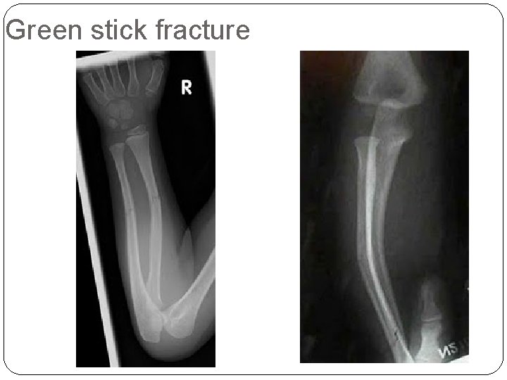 Green stick fracture 