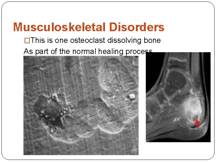 Musculoskeletal Disorders �This is one osteoclast dissolving bone As part of the normal healing