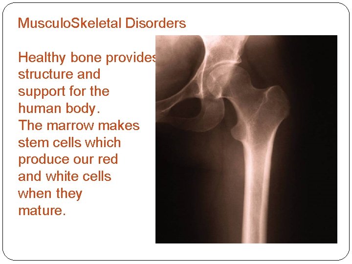 Musculo. Skeletal Disorders Healthy bone provides structure and support for the human body. The