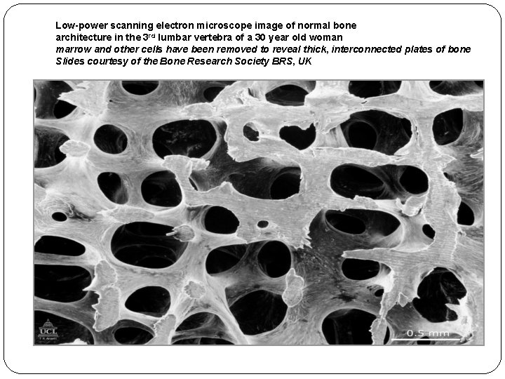 Low-power scanning electron microscope image of normal bone architecture in the 3 rd lumbar