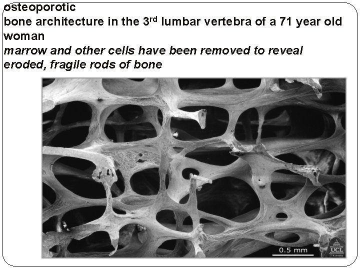 osteoporotic bone architecture in the 3 rd lumbar vertebra of a 71 year old