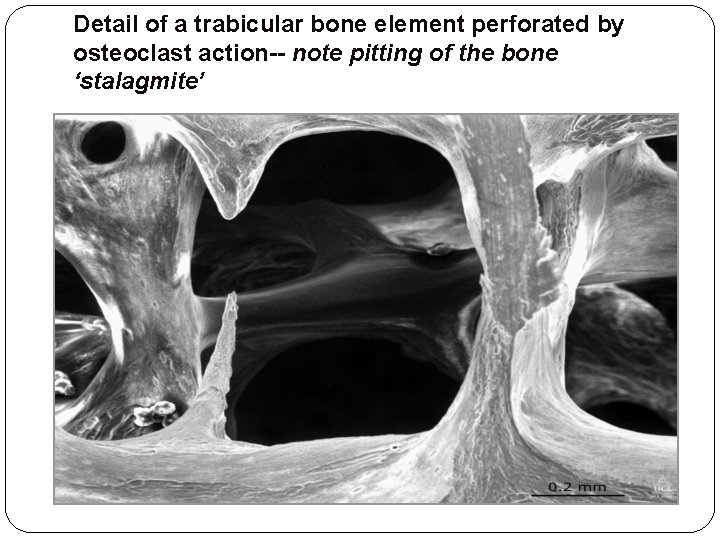 Detail of a trabicular bone element perforated by osteoclast action-- note pitting of the