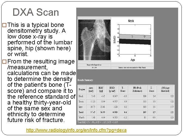 DXA Scan � This is a typical bone densitometry study. A low dose x-ray