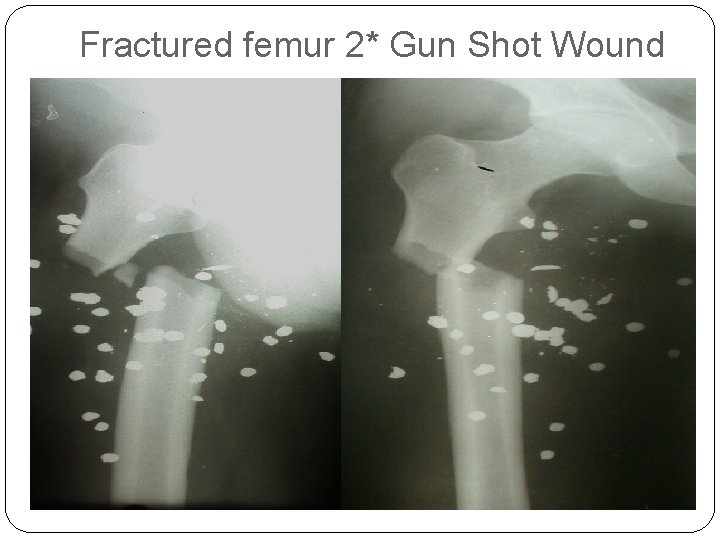 Fractured femur 2* Gun Shot Wound 