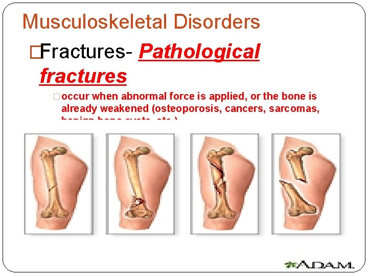 Musculoskeletal Disorders �Fractures- Pathological fractures �occur when abnormal force is applied, or the bone