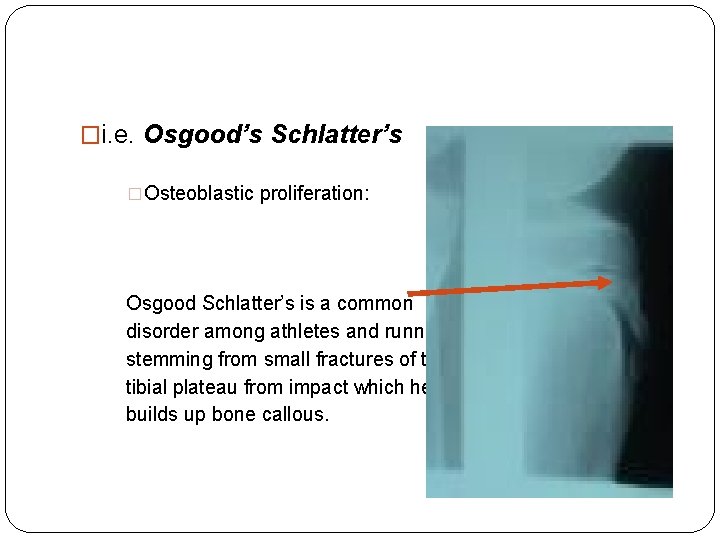 �i. e. Osgood’s Schlatter’s �Osteoblastic proliferation: Osgood Schlatter’s is a common disorder among athletes