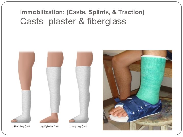 Immobilization: (Casts, Splints, & Traction) Casts plaster & fiberglass 