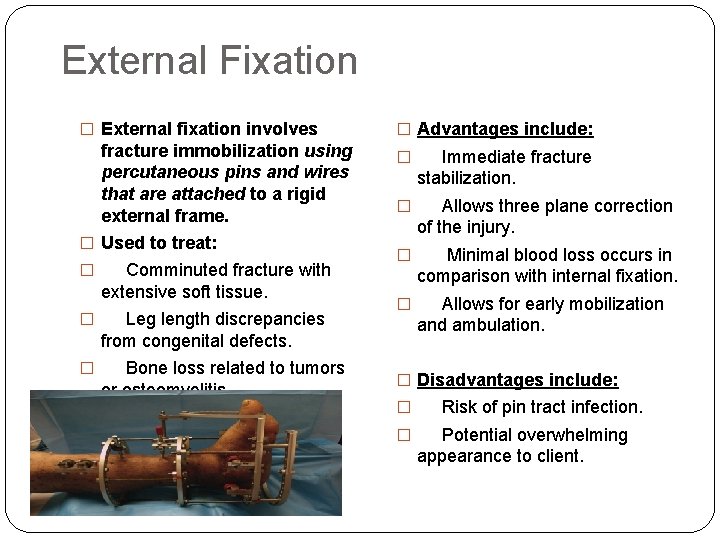 External Fixation � External fixation involves fracture immobilization using percutaneous pins and wires that