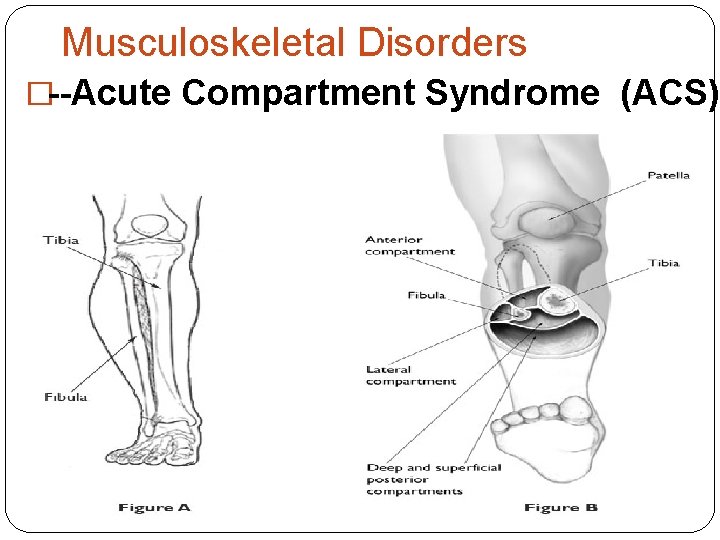 Musculoskeletal Disorders �--Acute Compartment Syndrome (ACS) 