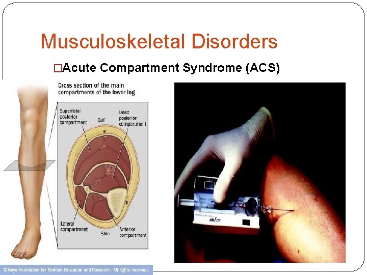 Musculoskeletal Disorders �Acute Compartment Syndrome (ACS) 
