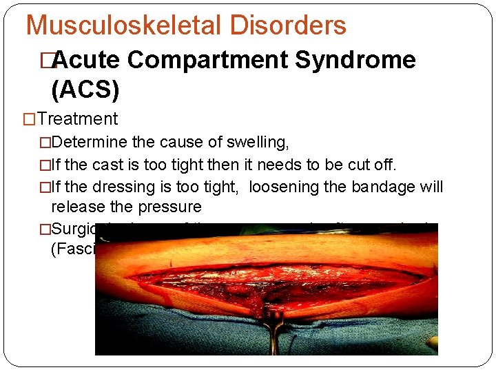 Musculoskeletal Disorders �Acute Compartment Syndrome (ACS) �Treatment �Determine the cause of swelling, �If the