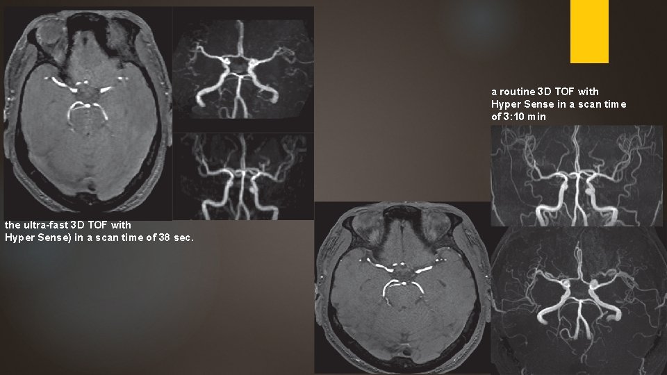 Compressed Sensing Multiband Mri A New Approach To