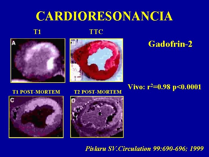 CARDIORESONANCIA T 1 TTC Gadofrin-2 T 1 POST-MORTEM T 2 POST-MORTEM Vivo: r 2=0.