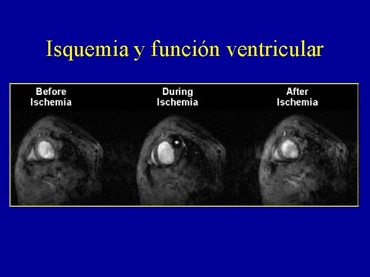 Isquemia y función ventricular 