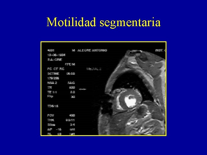 Motilidad segmentaria 