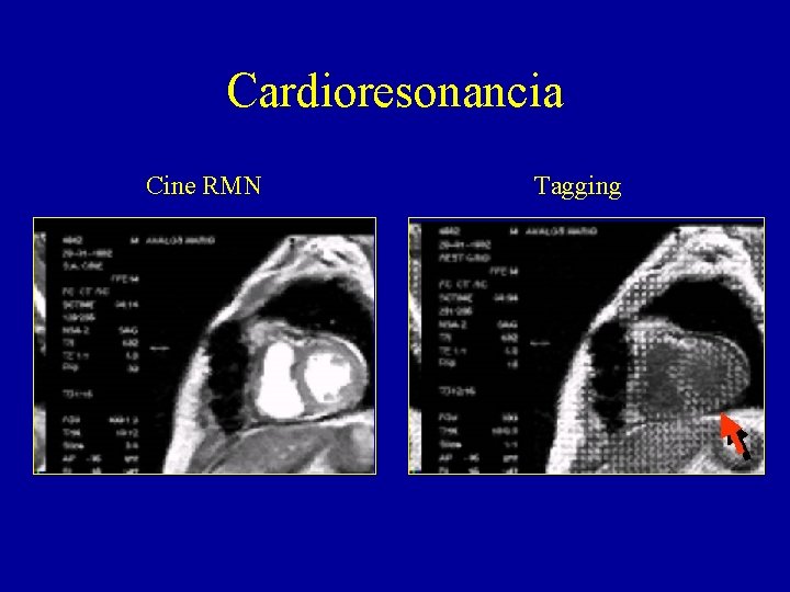 Cardioresonancia Cine RMN Tagging 