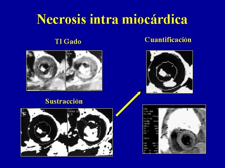 Necrosis intra miocárdica Tl Gado Sustracción Cuantificación 