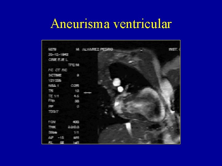 Aneurisma ventricular 