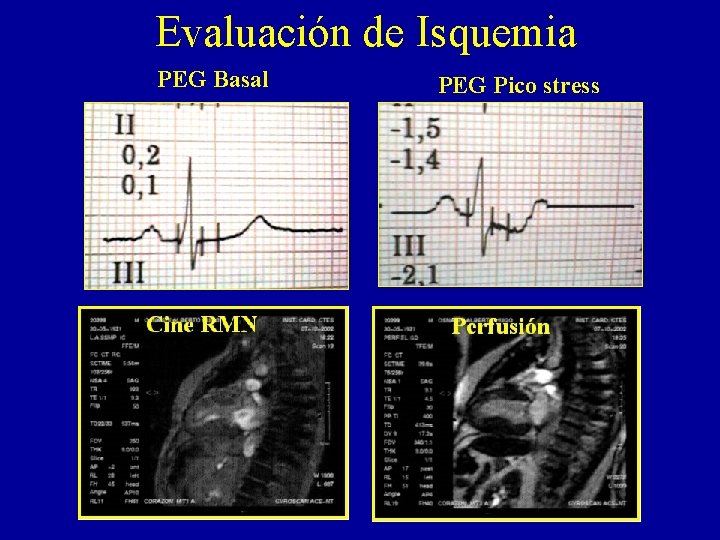 Evaluación de Isquemia PEG Basal PEG Pico stress 