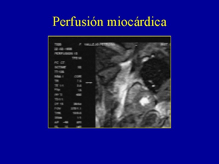 Perfusión miocárdica 