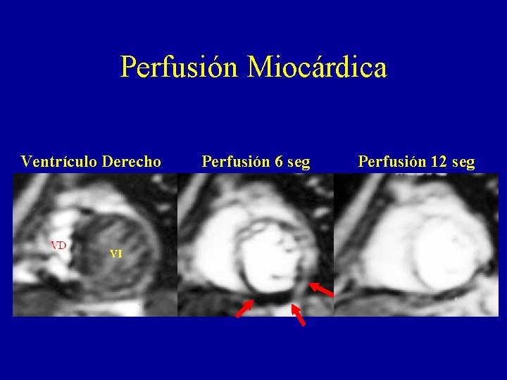 Perfusión Miocárdica Ventrículo Derecho Perfusión 6 seg Perfusión 12 seg 