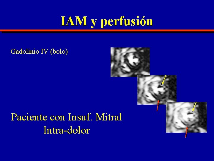 IAM y perfusión Gadolinio IV (bolo) Paciente con Insuf. Mitral Intra-dolor 