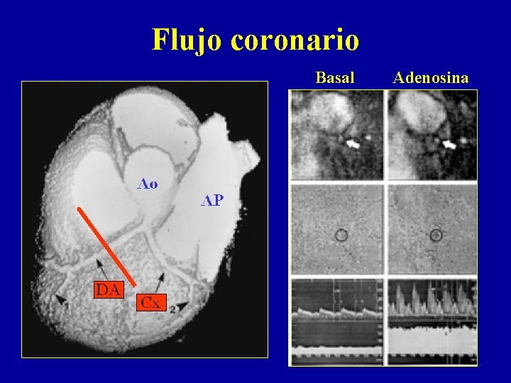 Flujo coronario Basal Adenosina 