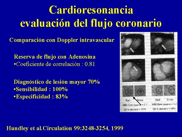 Cardioresonancia evaluación del flujo coronario Comparación con Doppler intravascular Reserva de flujo con Adenosina