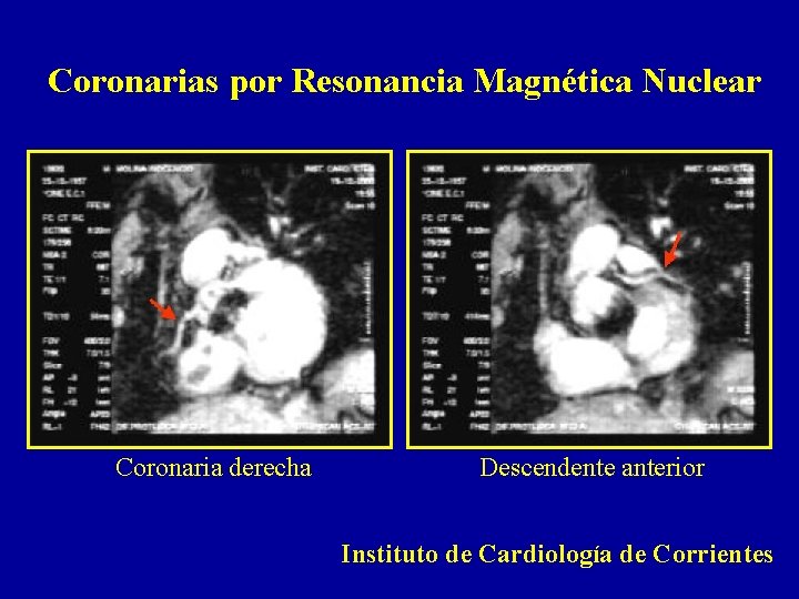 Coronarias por Resonancia Magnética Nuclear Coronaria derecha Descendente anterior Instituto de Cardiología de Corrientes