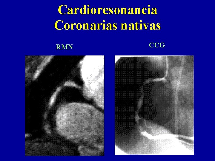 Cardioresonancia Coronarias nativas RMN CCG 