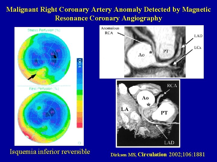 Malignant Right Coronary Artery Anomaly Detected by Magnetic Resonance Coronary Angiography Isquemia inferior reversible