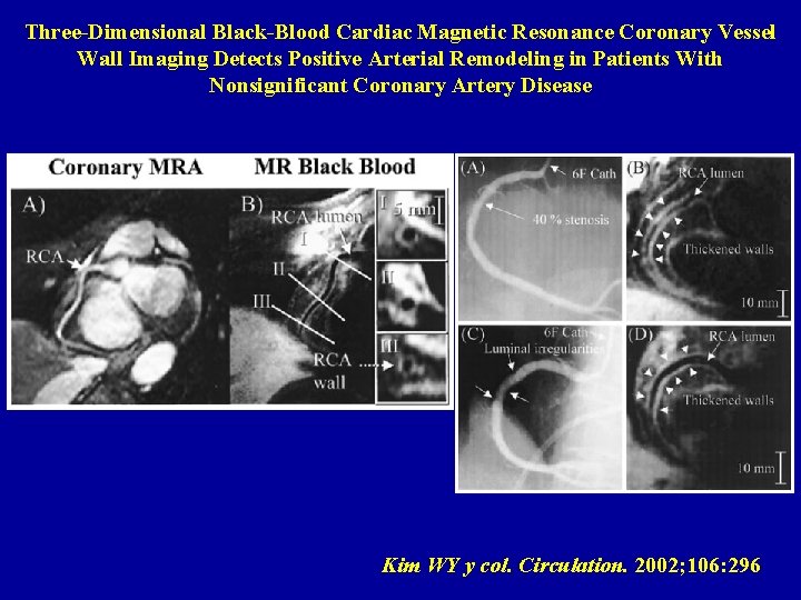 Three-Dimensional Black-Blood Cardiac Magnetic Resonance Coronary Vessel Wall Imaging Detects Positive Arterial Remodeling in